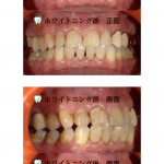 ホームホワイトニング(実例)