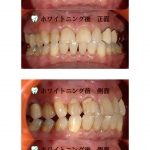 ホームホワイトニング（実例）